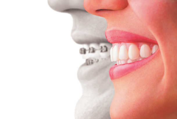 Invisalign Special - Bita Davoodian DDS - Redondo Beach Dentist